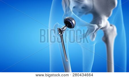 3d rendered medically accurate illustration of a hip replacement