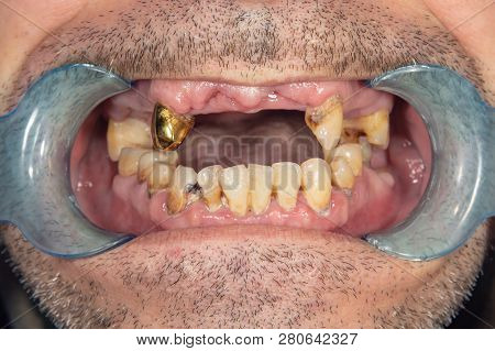 Rotten Teeth, Caries And Plaque Close-up In An Asocially Ill Patient. The Concept Of Poor Hygiene An