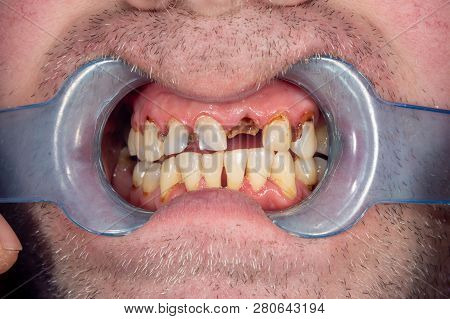 Rotten Teeth, Caries And Plaque Close-up In An Asocially Ill Patient. The Concept Of Poor Hygiene An