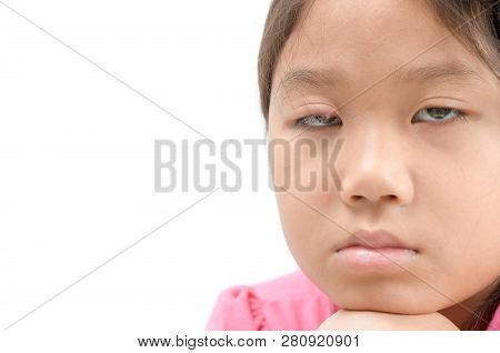 Sad Girl One Eye Infection Isolated On White Background, Eyelid Abscess, Stye, Hordeolum. Concept Of