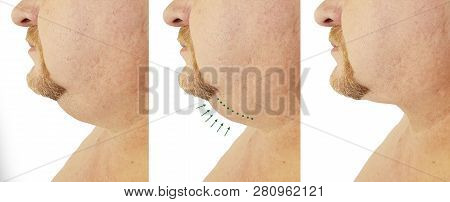 Submental Fat Man Before And After, Procedures