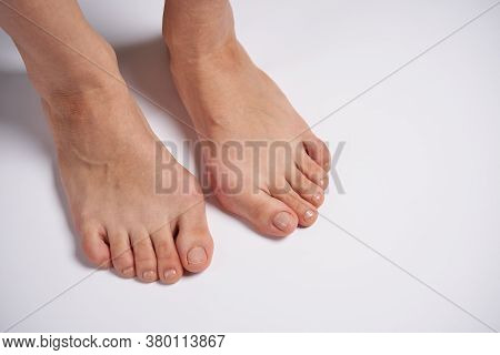 Hllux Valgus On Female Legs Close Up Isolated On White Background. Foot Joint Deformity. Health Care
