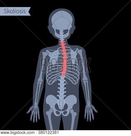 Thoracic Scoliosis In Child Body. Xray Flat Vector Illustration. Spine, Backbone, Joint And Skeleton
