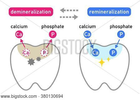 Diagram Of Tooth Demineralization And Remineralization. Dental Care Concept
