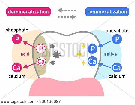 Diagram Of Tooth Demineralization And Remineralization. Dental Care Concept