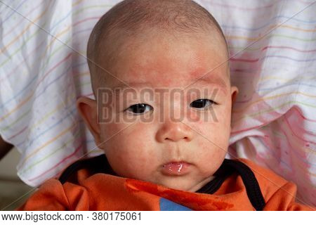 Newborn Baby In Fant Has Face Allergy Or Rash