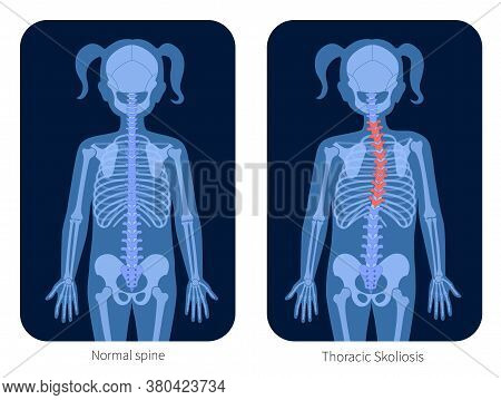 Normal Spine And Thoracic Scoliosis In Girl Body. Xray Flat Vector Illustration. Backbone, Joint And