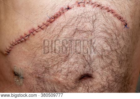 Postoperative Suture After Oncological Surgery On The Liver, Abdominal Surgery, At The Bottom Left O