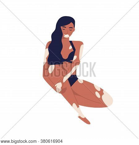 Young Self Acceptance Woman With Vitiligo Relaxing In Bikini. Body Positive, Brunette Girl With Skin