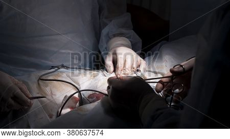 Surgical Team Operating Male Genitals In An Operation Theater. Action. Close Up Of Surgeons Removing