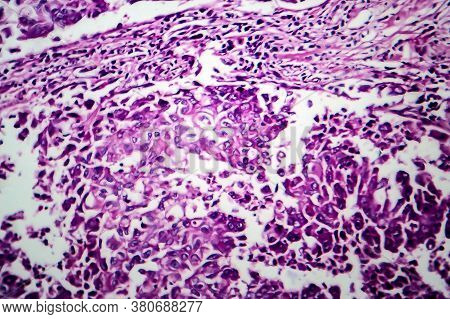 Breast Ductal Carcinoma, Light Micrograph, Photo Under Microscope
