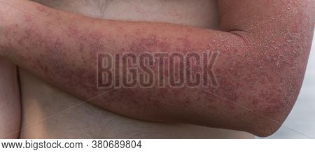 Dyshidrotic Autoimmune Eczema Of Patient. Concept Of Health Care