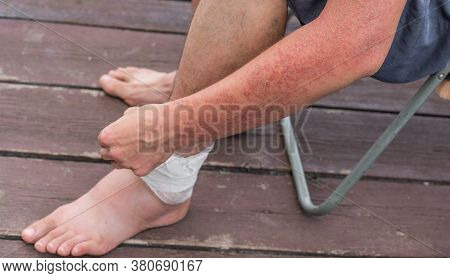 Dyshidrotic Autoimmune Eczema Of Patient. Concept Of Health Care