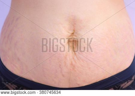 Womans Abdomen After Carboxytherapy Injections In Clinic, Closeup View. Treatment, Cure And Removig 