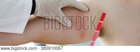 Close-up Of Doctor Dermatologist Doing Test Of Body Stain. Allergic Urticaria On Dermal Edema Quinck