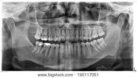 Original black white x-ray teeth scan mandible