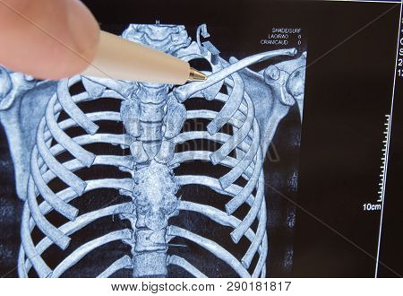 Doctor Points Out Pen On Clavicle In Picture Of 3d Computer Tomography. Anatomical Location Of Colla