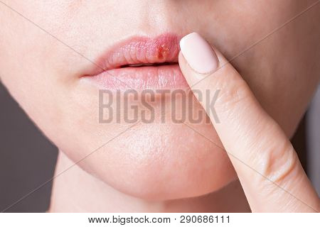 Part Of A Woman's Face , Herpes On The Lips, Beauty Concept
