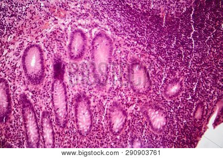 Acute Simple Appendicitis, Light Micrograph, Photo Under Microscope