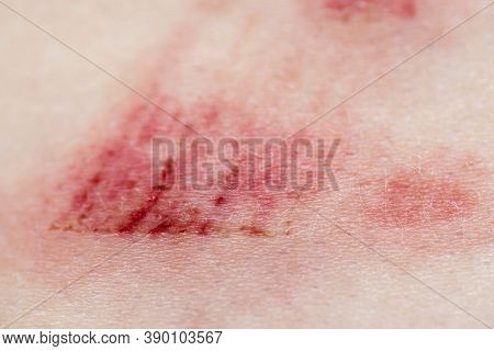 A Wound On The Human Body. Very Close Up Of Painful Wound.