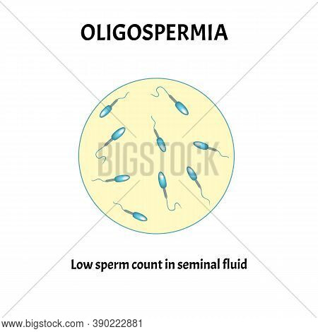 Low Sperm Count In Seminal Fluid. Low Abundance Of Sperm In The Ejaculate. Male Infertility Oligospe