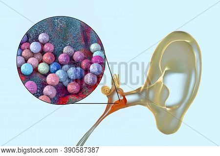Otitis Media Caused By Bacteria Staphylococcus Aureus, An Inflammatory Disease Of The Middle Ear, 3d