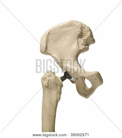 인간의 엉덩이 관절 수술 비