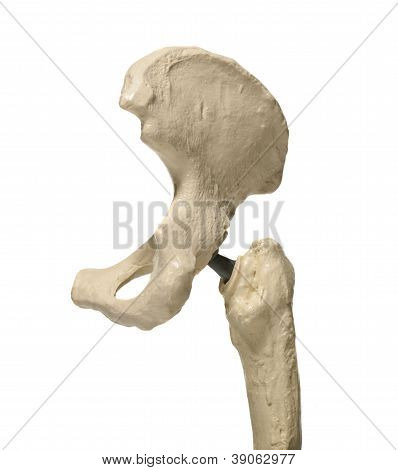 인간의 엉덩이 관절 수술 비