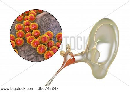 Otitis Media Caused By Bacteria Staphylococcus Aureus, An Inflammatory Disease Of The Middle Ear, 3d
