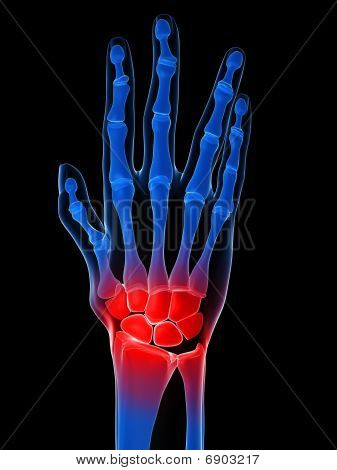 skeletal hand - arthritis