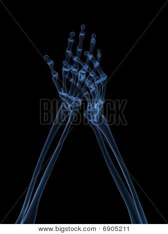 x-ray hands - arthritis