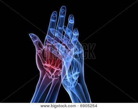 x-ray hands - arthritis
