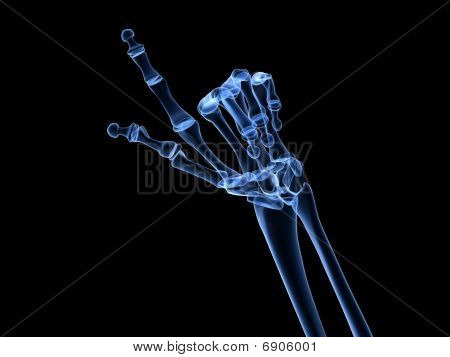 x-ray hand - arthritis