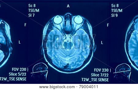Real brain MRI slide of a young woman. Patient's and clinic's names removed