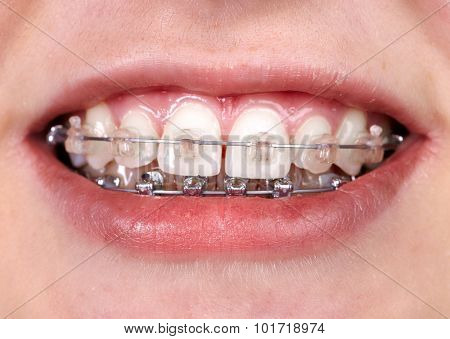 Teeth with orthodontic brackets. Dental health care.