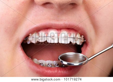 Teeth with orthodontic brackets. Dental health care.
