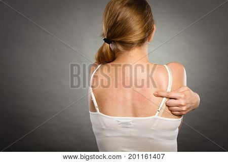 Woman Scratching Her Itchy Back With Allergy Rash