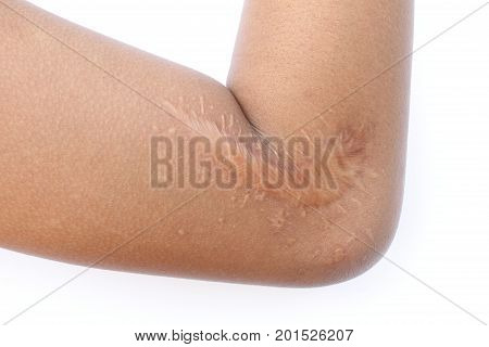 Scar on the arm isolated on white background