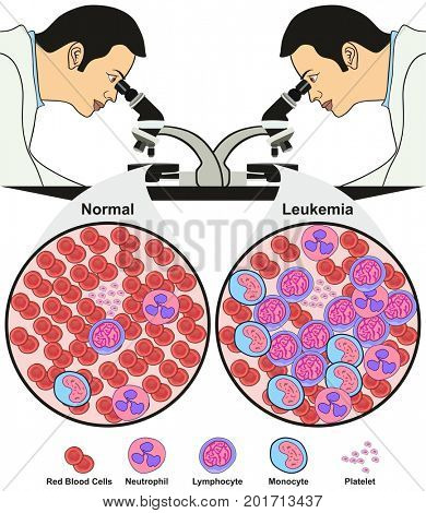 Leukemia Diagnosis Diagram showing doctor in lab looking through microscope diagnoses a normal blood sample while other is affected with disease for medical science education and healthcare awareness