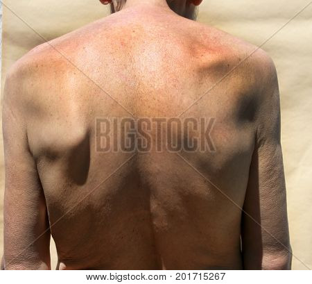 Scoliosis. Rachiocampsis. Kyphosis Curvature of the spine