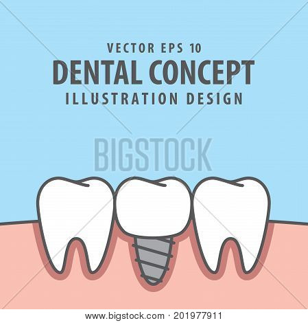 Implant Tooth Between Real Teeth Illustration Vector On Blue Background. Dental Concept.