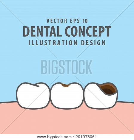 Caries And Cavity Teeth Illustration Vector On Blue Background. Dental Concept.