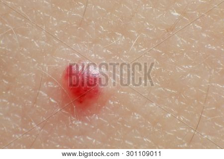 Cherry Angiomas On Male Skin - Super Macro Close Up