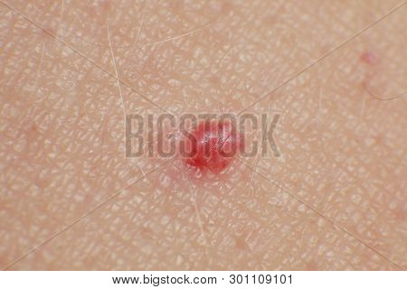 Cherry Angiomas On Male Skin - Super Macro Close Up