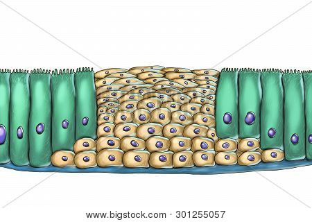Squamous Metaplasia Or Respiratory Epithelium, A Consequence Of Cigarette Smoking , Illustration