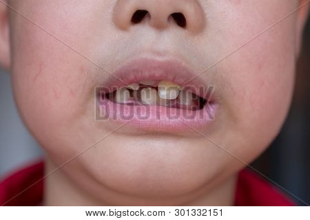 Little Child And Broken Teeth, Healthcare Concepy