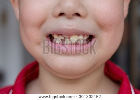 Little Child And Broken Teeth, Healthcare Concepy