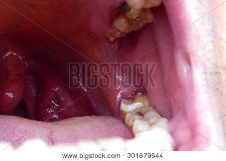 Tonsils Deformed, Tonsillitis, Neglected Poor Human Mouth Interior,