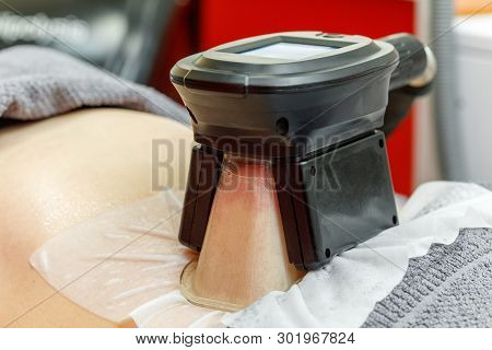 Cryolipolysis Freeze Fat Procedure In Cosmetic Cabinet Or Spa Salon, Belly Close-up