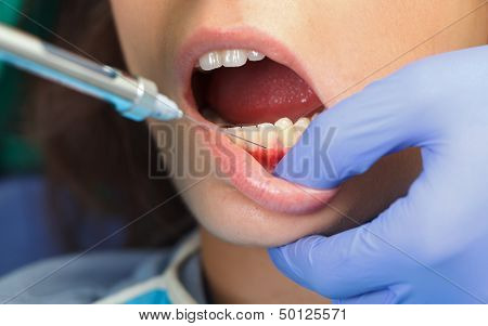 Dental Anesthesia